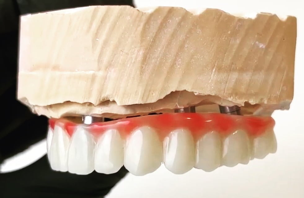 cat rezista un implant dentar, cau dureaza un implant dentar. cat timp dureaza un implant dentar