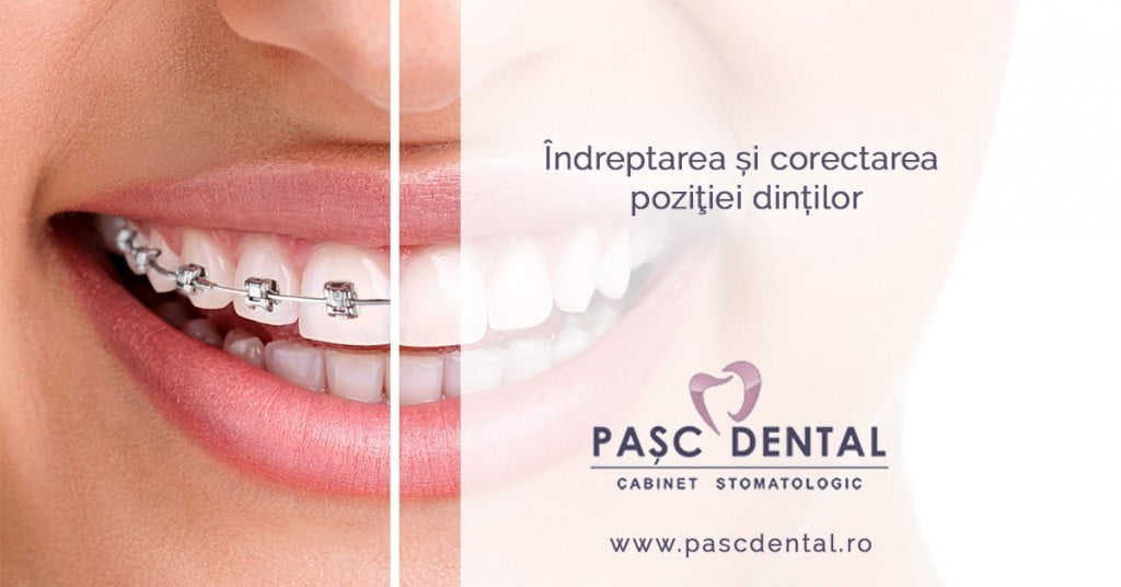 indreptarea si corectarea pozitiei dintilor, metode de indreptare a dintilor, muscatura corecta a dintilor, aparat dentar pentru corectarea muscaturii, indreptarea dintilor